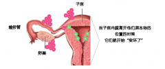 子宫内膜异位症—正在损害卵子质量