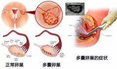 瘦型的多囊卵巢综合征该如何治疗？