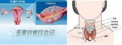 多囊卵巢综合征为什么要查甲功？