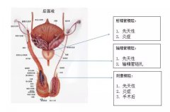 梗阻性无精子症—— 有希望治愈的疾病