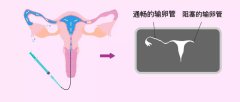 输卵管通畅性检查的方法